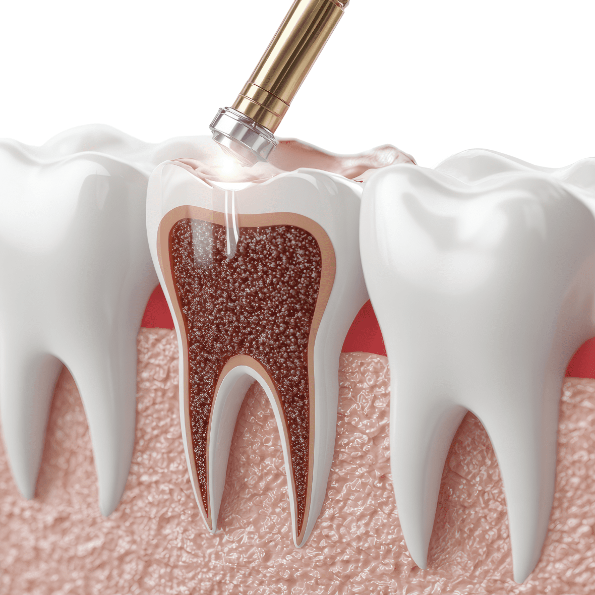 Root Canal Treatment