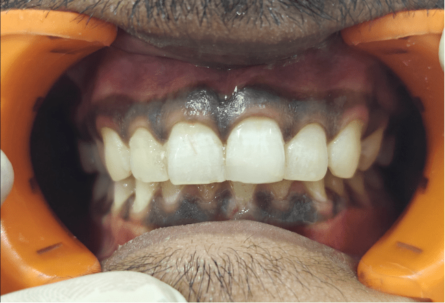 Surat's Best dental filling Result