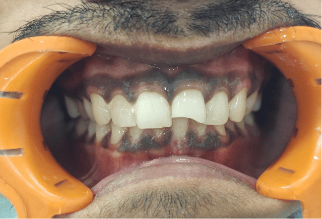 Surat's Best dental filling Results