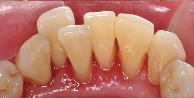 Teeth Cleaning After 1