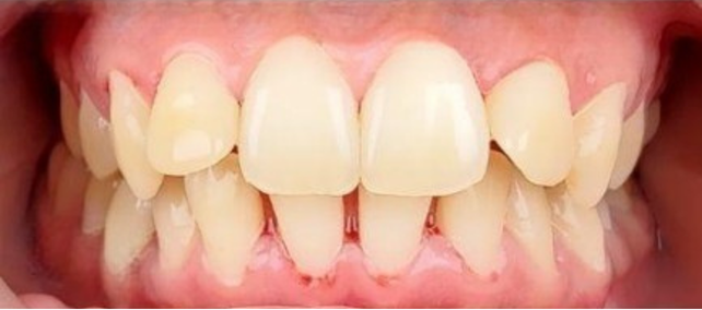 Teeth Cleaning After 3