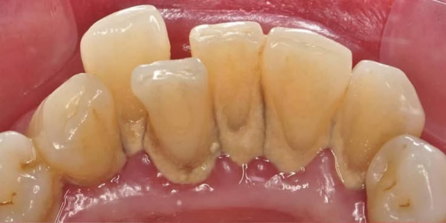 Teeth Cleaning Before 1