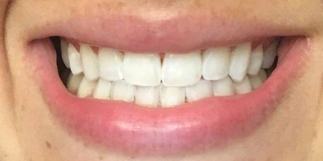 Tooth Whiteing result 2 After