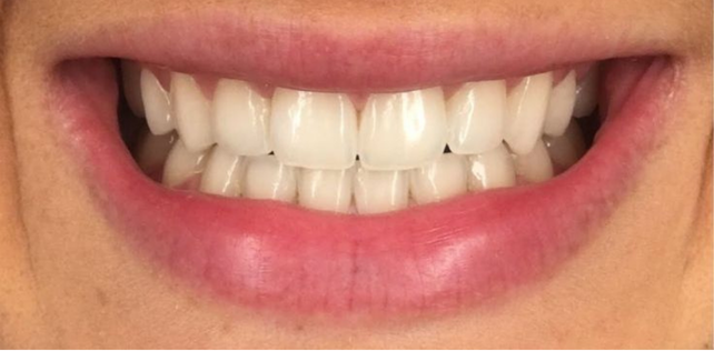 Tooth Whiteing result 2 Before