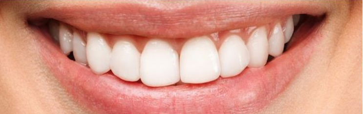 Tooth Whiteing result 3 After