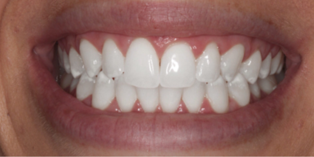 Tooth Whiteing result After
