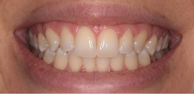 Tooth Whiteing result before