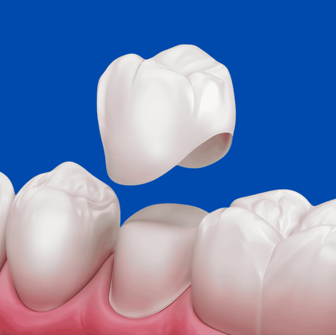 Top Dental Crowns and Bridges in Surat