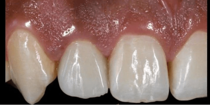 temporary crowns after