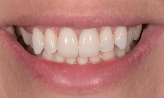 temporary crowns after