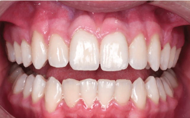 Dental Braces After