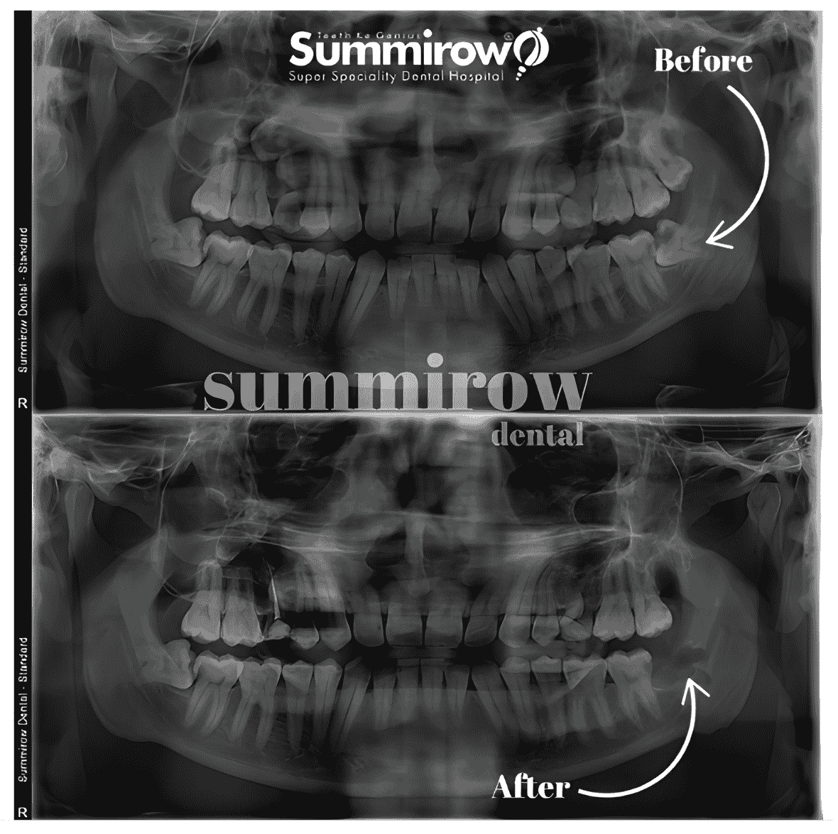 Wisdom Tooth Removal