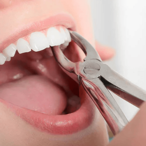 Wisdom Tooth Removal-2