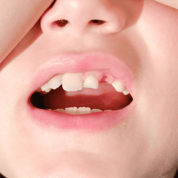 Wisdom Tooth Removal-3