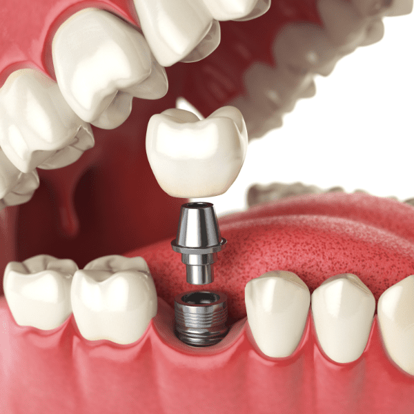best dental implants in south gujarat