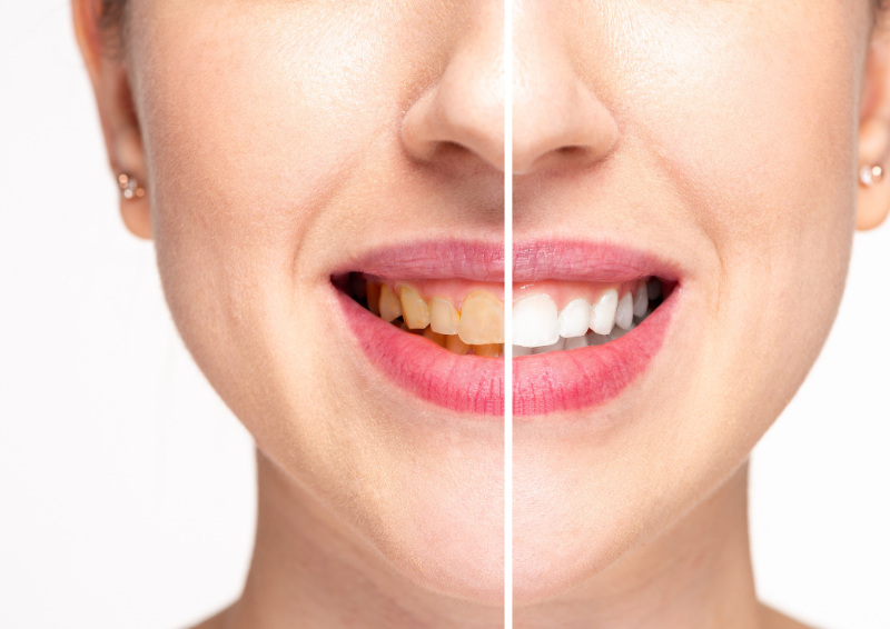 Best teeth whitening in surat