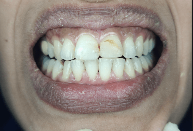 dental scaling and polishing After treament