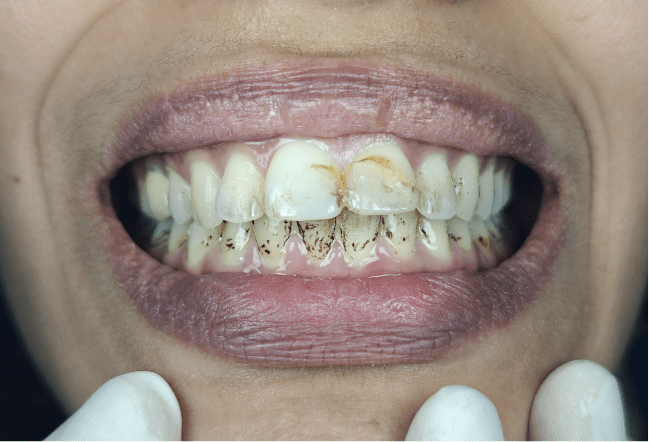 dental scaling and polishing before treament