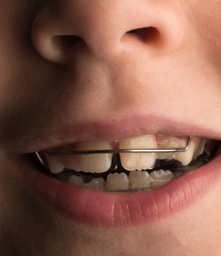 pedo orthodontics - 2