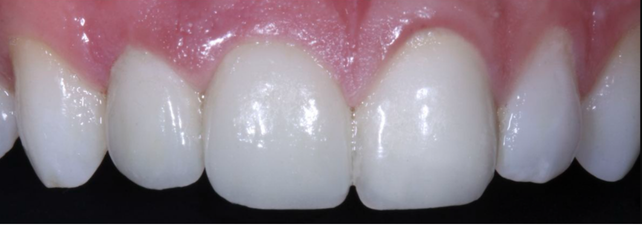 After Root canal Treatment