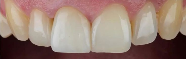 After best Root canal Treatment IN SURAT