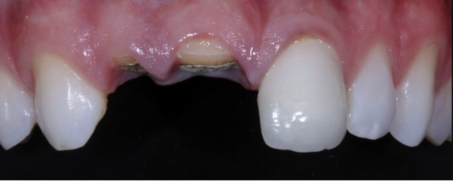 Before Root canal Treatment