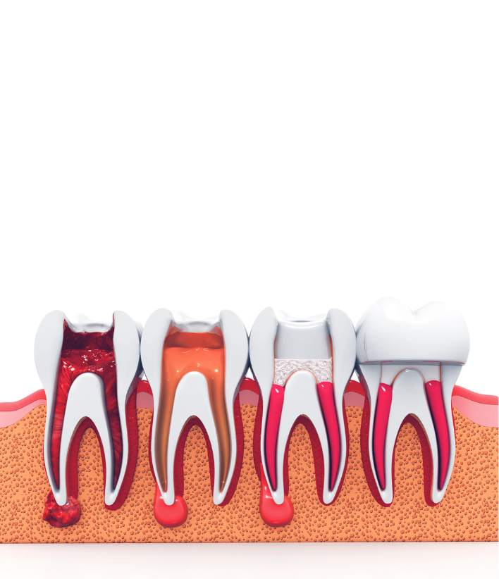 Root Canal (RC) Treatment in Surat