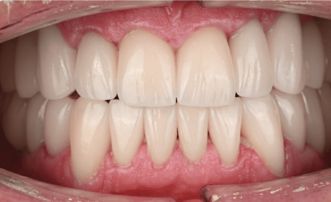 Smile makeover result 1 after