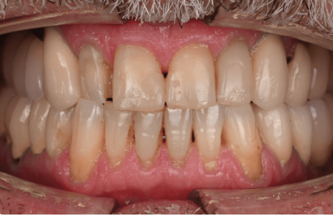 Smile makeover result 1 before