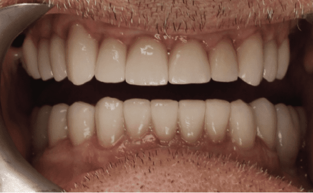 Smile makeover result 2 after