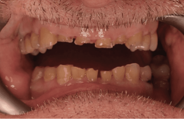 Smile makeover result 2 before