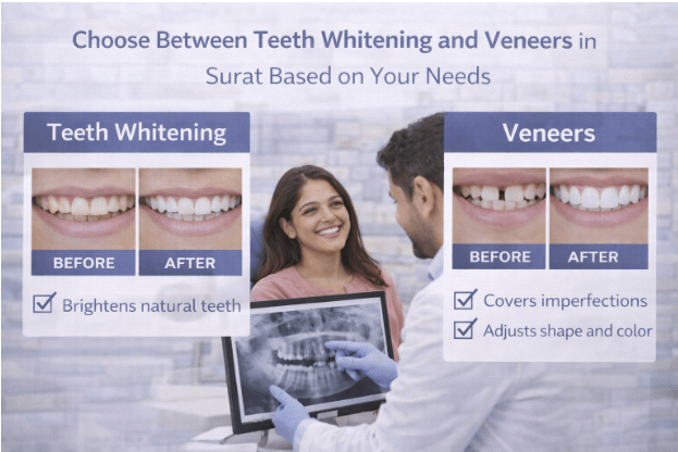 Dental Veneers Surat
