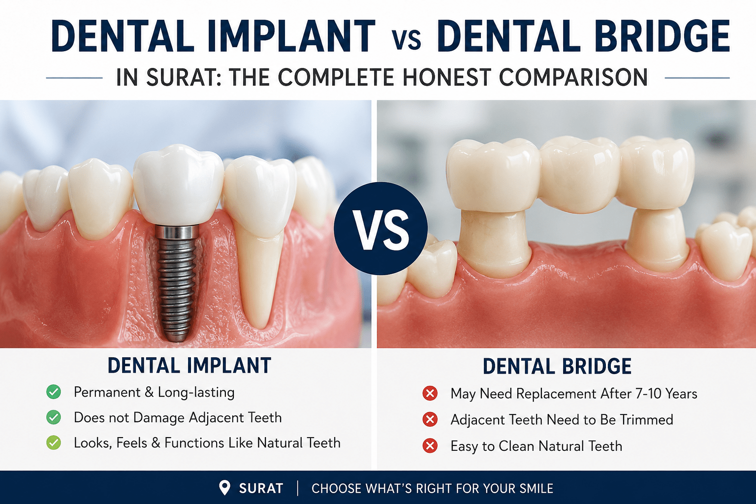 dental implant vs bridge Surat