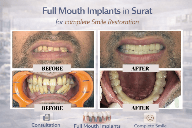 permanent teeth replacement Surat