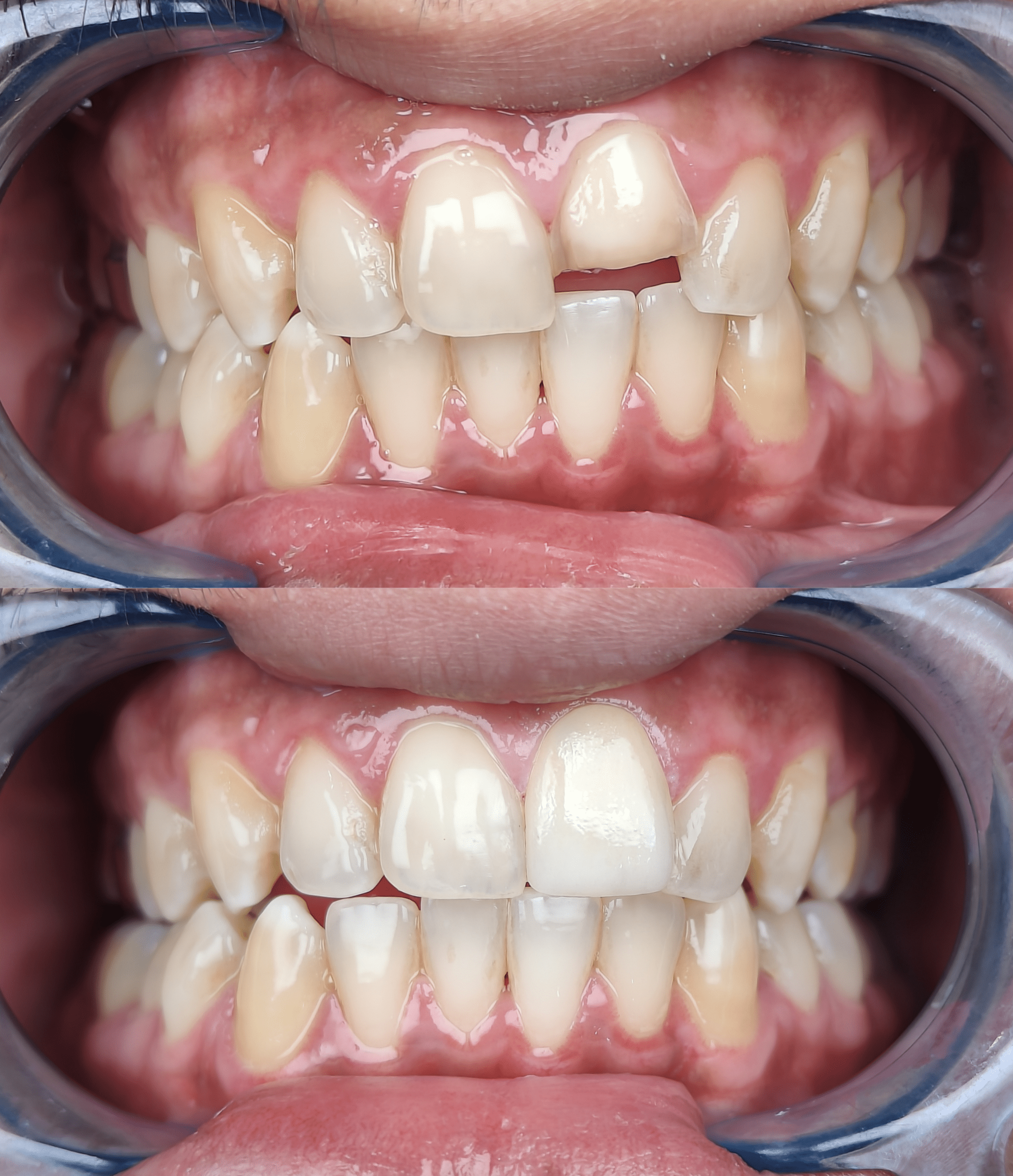 Before and after cleat cligners teeth specing result at Summirow Dental Surat