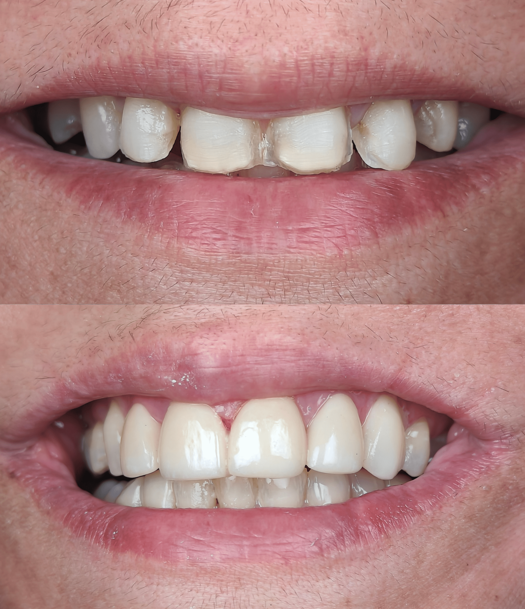 Before and after Teeth Replacement r result at Summirow Dental Surat