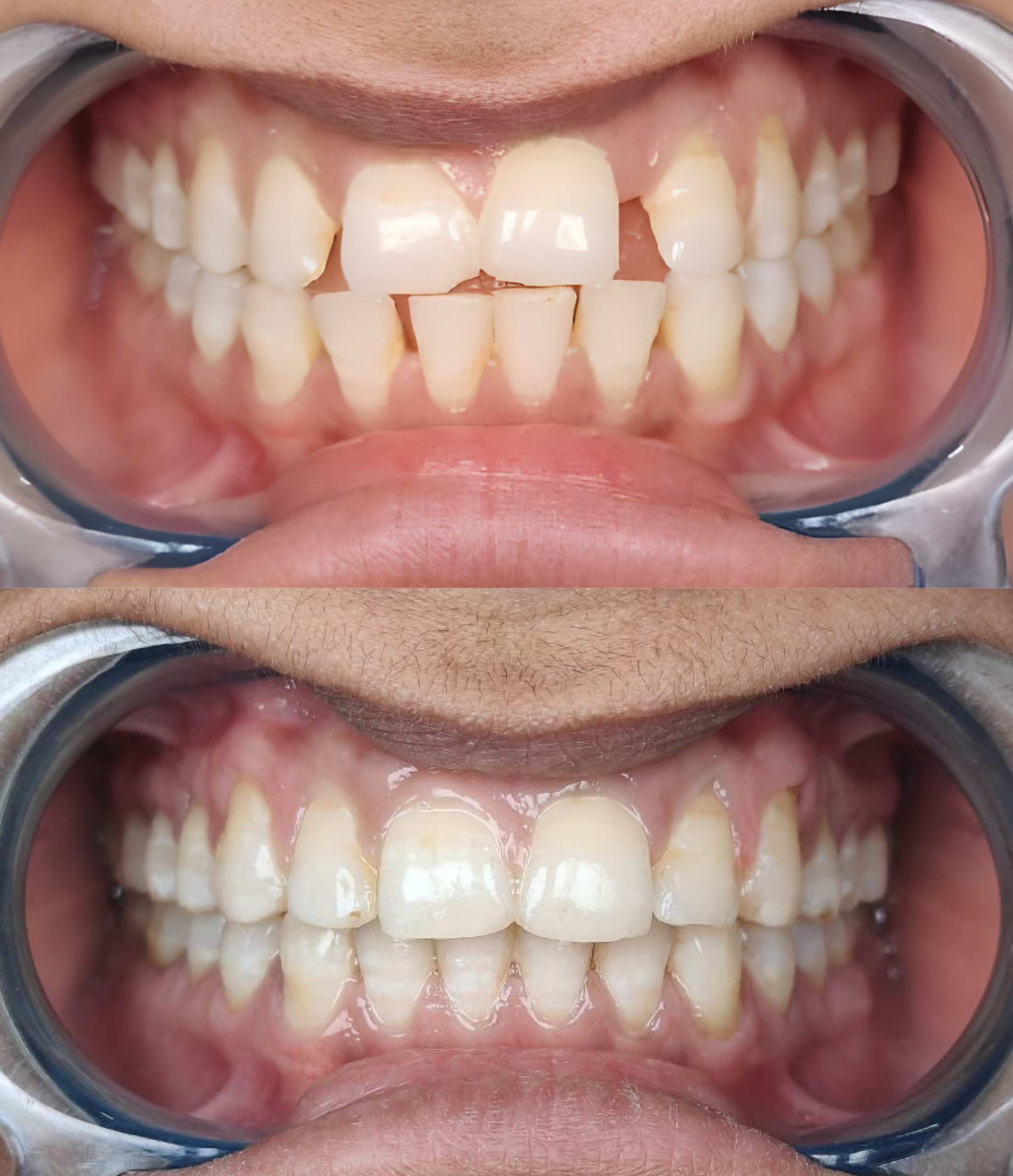 Before and after Veneermidline gap at Summirow Dental Surat
