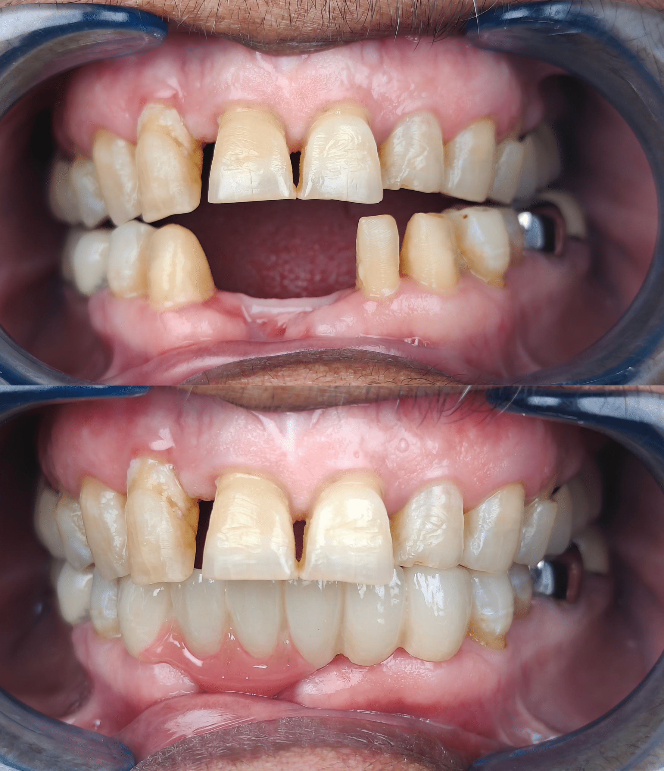 Before and after Front teeth fap closure result at Summirow Dental Surat