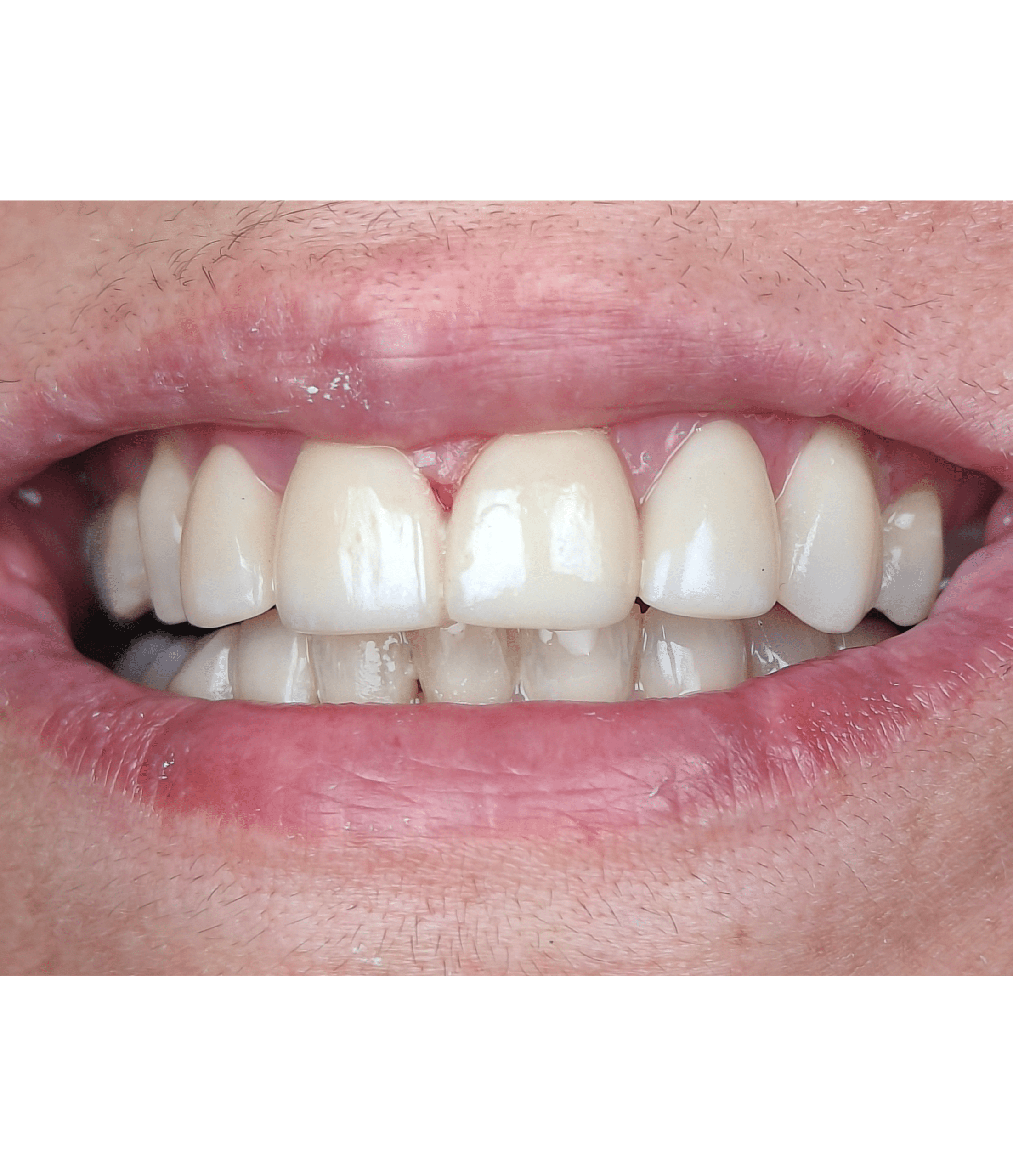 After — Smile Makeover Surat