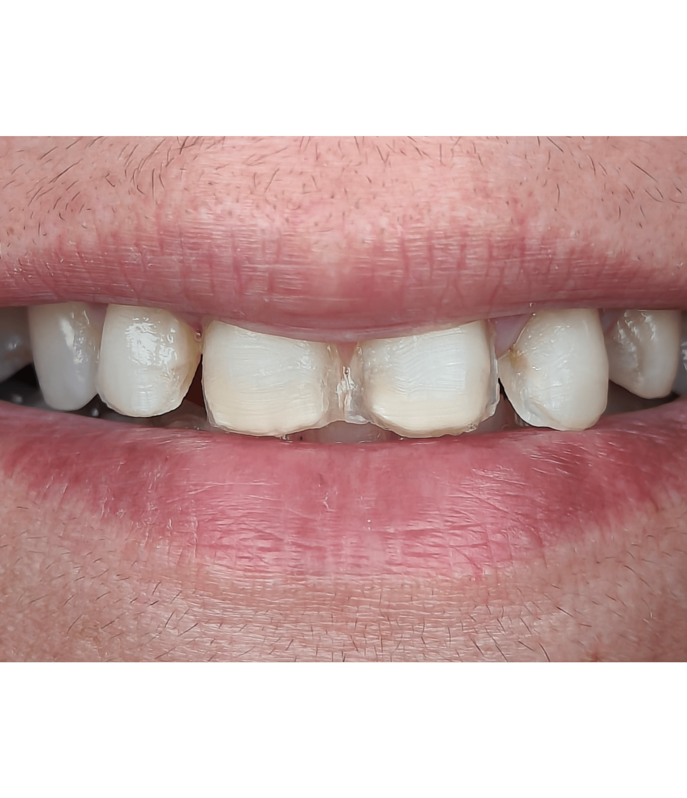 Before — Dental Veneer Treatment in Surat