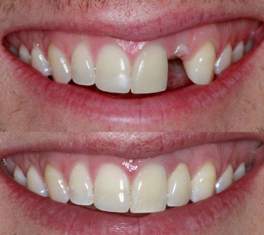 Missing teeth replaced with dental implants — before and after