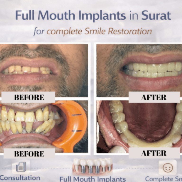 permanent teeth replacement Surat